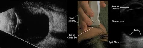 Ocular Imaging Eye Ultrasound Or B Scan Radiology Nagpur
