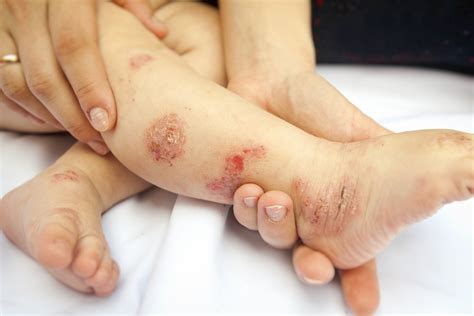 Dermatite Atópica Causas Sintomas e Tratamentos ATUALIZADO