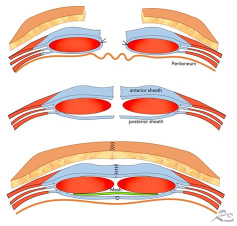 The Radiology Assistant Abdominal Wall Hernias