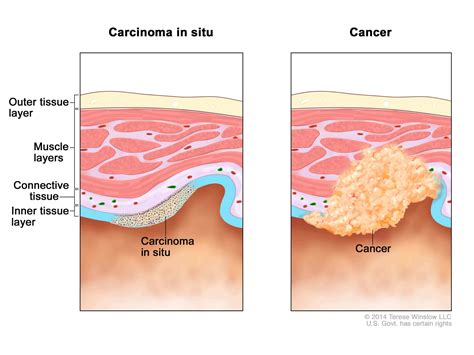 What Is A Sarcoma Cancer