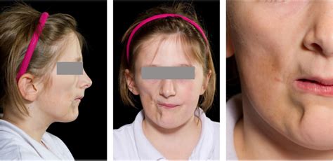 parry romberg syndrome an unusual case with dental features