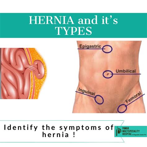 Hernia In Most Cases Occurs As A Painless Swelling In Any Of The Sites