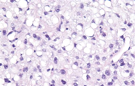 Myxoid Liposarcoma Mypathologyreportca
