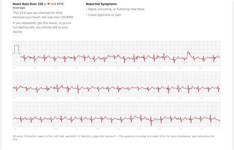 I Have Been Told I Have An Irregular Heart Rhythm By My Cardiologist