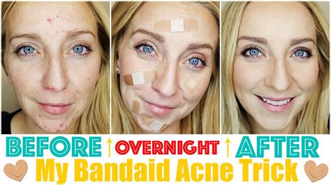 How To Get Rid Of Acne Fast And Overnight With My Band Aid Trick It
