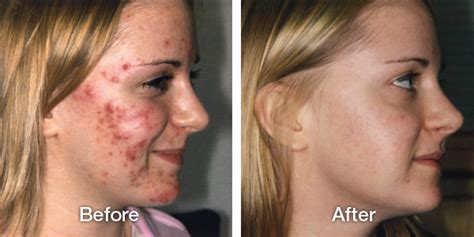 Antibiotics and Acne - always good? | Dr. Anil