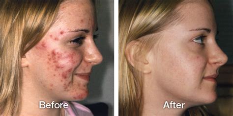 Acne Treatment Antibiotics