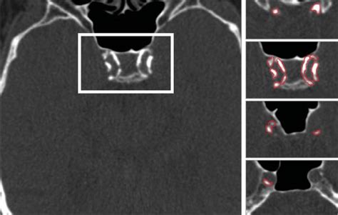 Example Of Calcification Of The Intracranial Internal Carotid Artery B