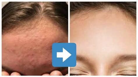 Get Rid Of Tiny Bumps On Facehow To Remove Tiny Bumps Very Simple
