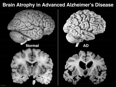 Iron Levels Can Predict Alzheimers Disease Gazette Review