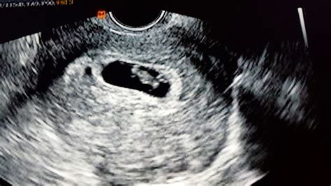 Ultrasound At 7 Weeks 5 Days Youtube
