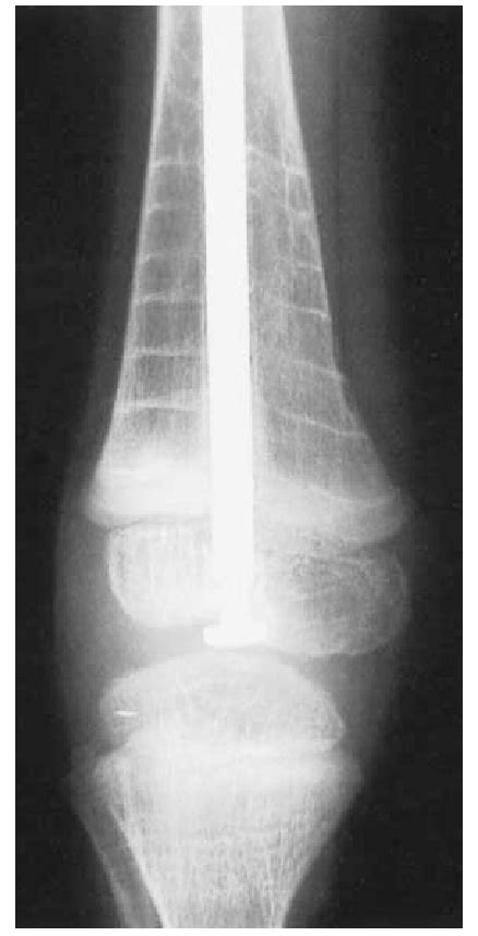 Anteroposterior Radiograph Showing Sclerotic Bands In The Metaphysis Of