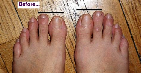 My Toe Shortening Surgery And Hammertoe Hammer Toe Surgery Blog Before And Afters 2 Months
