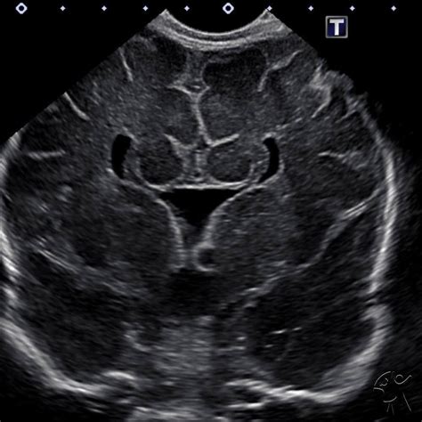 Cincy Kids Radiology On Twitter Head Ultrasound In A Neonate Shows An