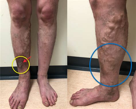 Varicose Veins In Primary Care The Bmj