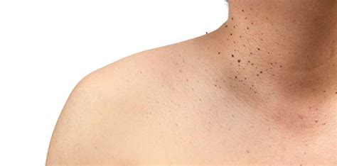 Keratosis Symptoms Causes Treatments Clear Skin Clinic
