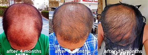 Is hair transplant possible with stem cells? the viewing deck: Stem-Cell FUE Hair Transplant and PRP ...