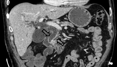 Ct View Showing Dilatation Of Both The Bile And Pancreatic Ducts
