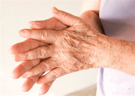 Age Spots Symptoms And Treatments Dermatology Inc