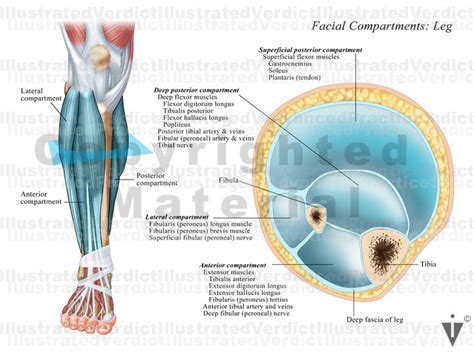Stock Lower Limb Compartment Syndrome — Illustrated Verdict