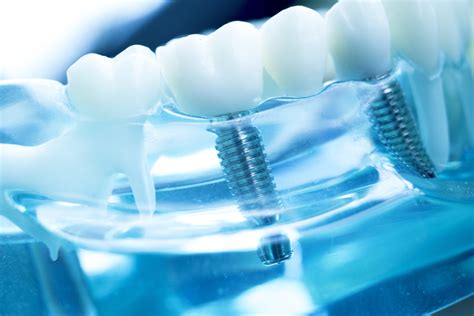 Implant Posts For Various Circumstances Prosthodontist In Overland