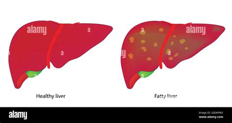 Fatty Liver And Healthy Liver Healthy Liver And Fatty Liver Fatty