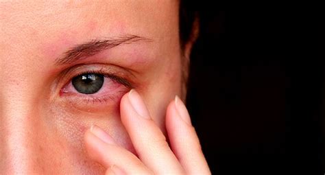 What Causes Watery Eyes And How To Treat Them Centre For Sight