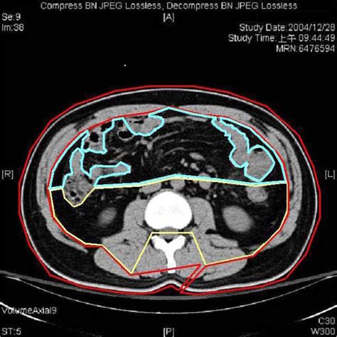 The Ct Of Abdomen Shows Measurement Of Intra Peritoneal Fat Blue