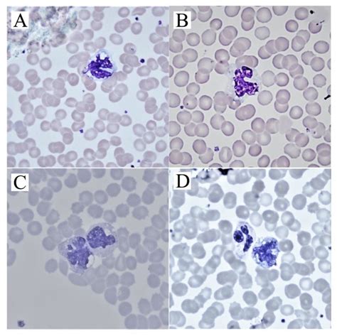 A B The Monocytes With Vacuoles That Generally Increased During