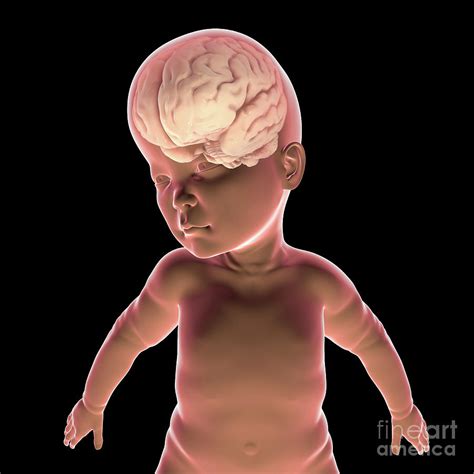 Child With Macrocephaly And Enlarged Brain Photograph By Kateryna Kon