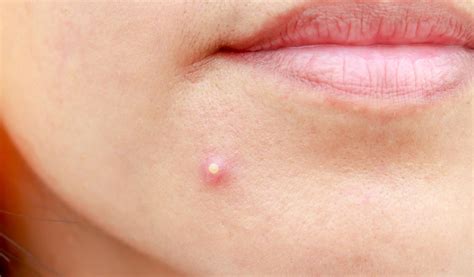 Boil Vs Pimple Definition Causes And How To Treat And Tiege Hanley