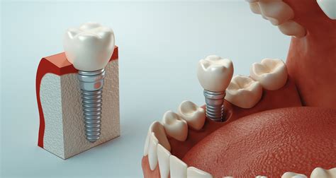 Implantología Oral De Carga Inmediata Dentadura Fija En Una Sola