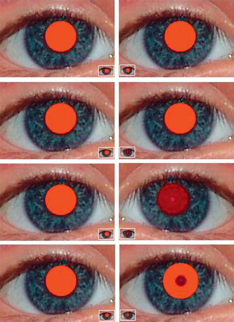Fundusrotreflex Test Augenscreening In Der Pädiatrie
