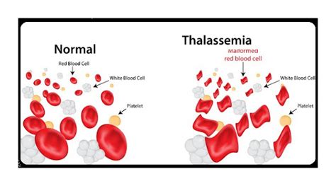 Sekitarku Thalassemia Bukan Kelainan Yang Bisa Disepelekan