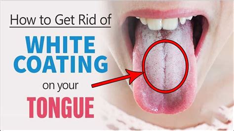 How To Get Rid Of Coated Tongue Home Remedies For White Coated