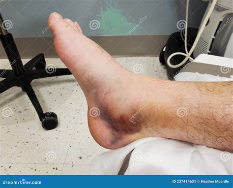Contusion And Blister On Exposed Patient Leg In ER Stock Image Image Of Instrument