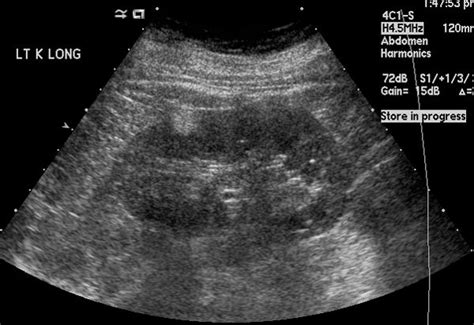 Angiomyolipoma Ultrasound Wikidoc