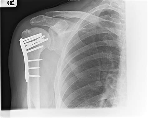 Proximal Humerus Fractures Yorkshire Shoulder Clinic