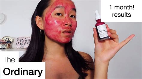 The Ordinary Aha 30 Bha 2 Peeling Solution Honest Review 1 Month Real Results Youtube
