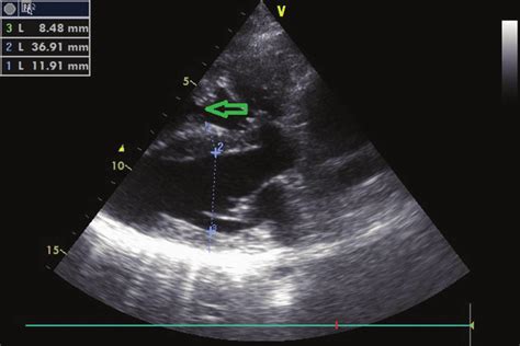 Parasternal Long Axis View Arrow Indicating Marked Muscle Band
