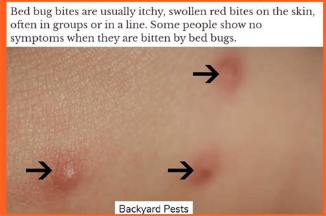 Bed Bug Reaction