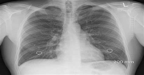 Mesothelioma cancer is most often linked to exposure to asbestos, but many other factors affect who is most likely to nobody disputes that asbestos is the principal cause of mesothelioma cancer. Asbestos Lung Cancer: Discover the Causes, Diagnosis ...
