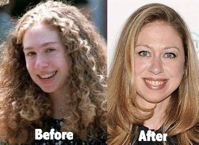 Chelsea Clinton before and after plastic surgery (15 ...