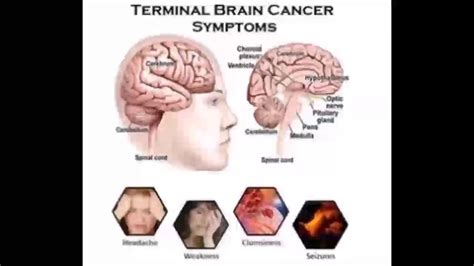Stages Of Brain Cancer Symptoms Check My Xxx Hot Girl