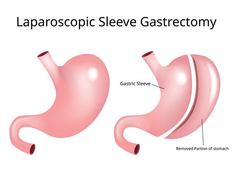 Sleeve Gastrectomy Procedure And All About It Healing Clinic Turkey