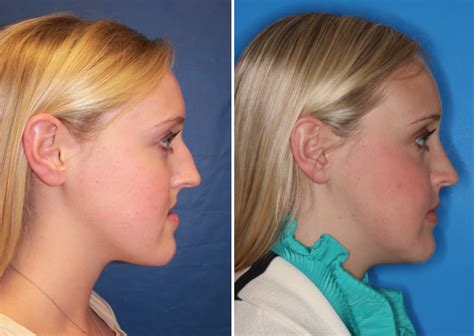 Before And After Case 15b Mandible Surgery Larry M Wolford Dmd