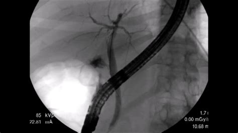 Fistulotomy During Ercp In Patient With Bile Leak Youtube