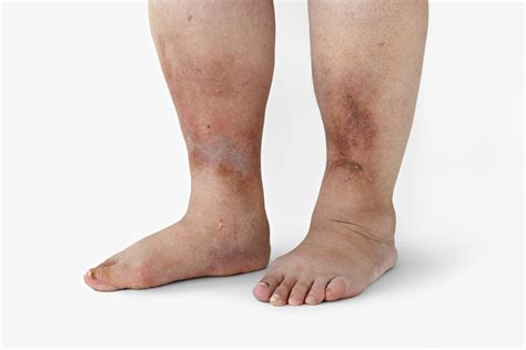 The Possible Causes Of Feet Discoloration