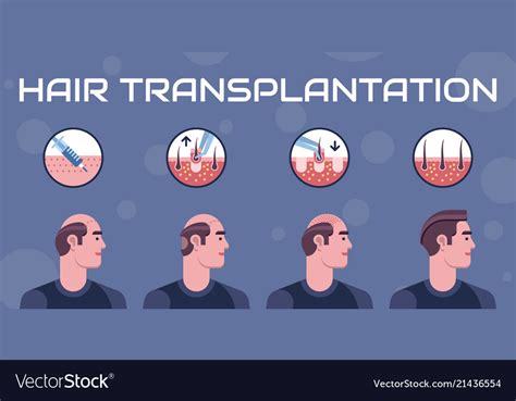 Hair Transplantation Steps Royalty Free Vector Image