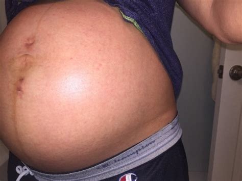 What Do Stretch Marks Look Like On Pregnant Belly Pregnantbelly